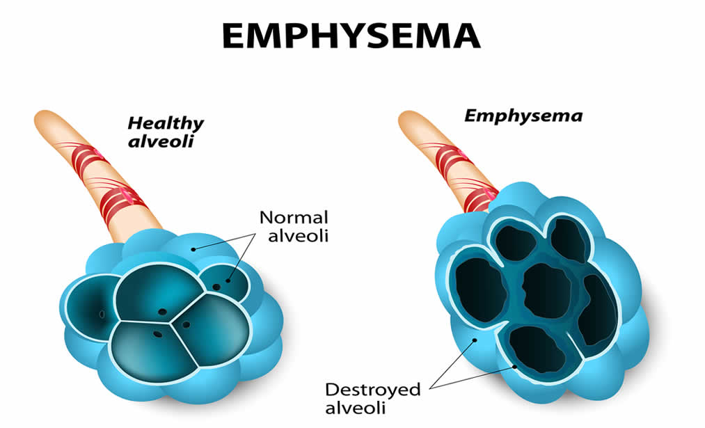 Emphysema In Lungs