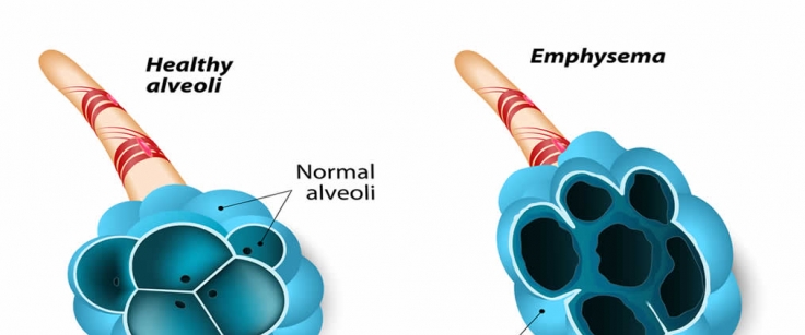 5 Steps to Better Breathing With Emphysema – Expand a Lung